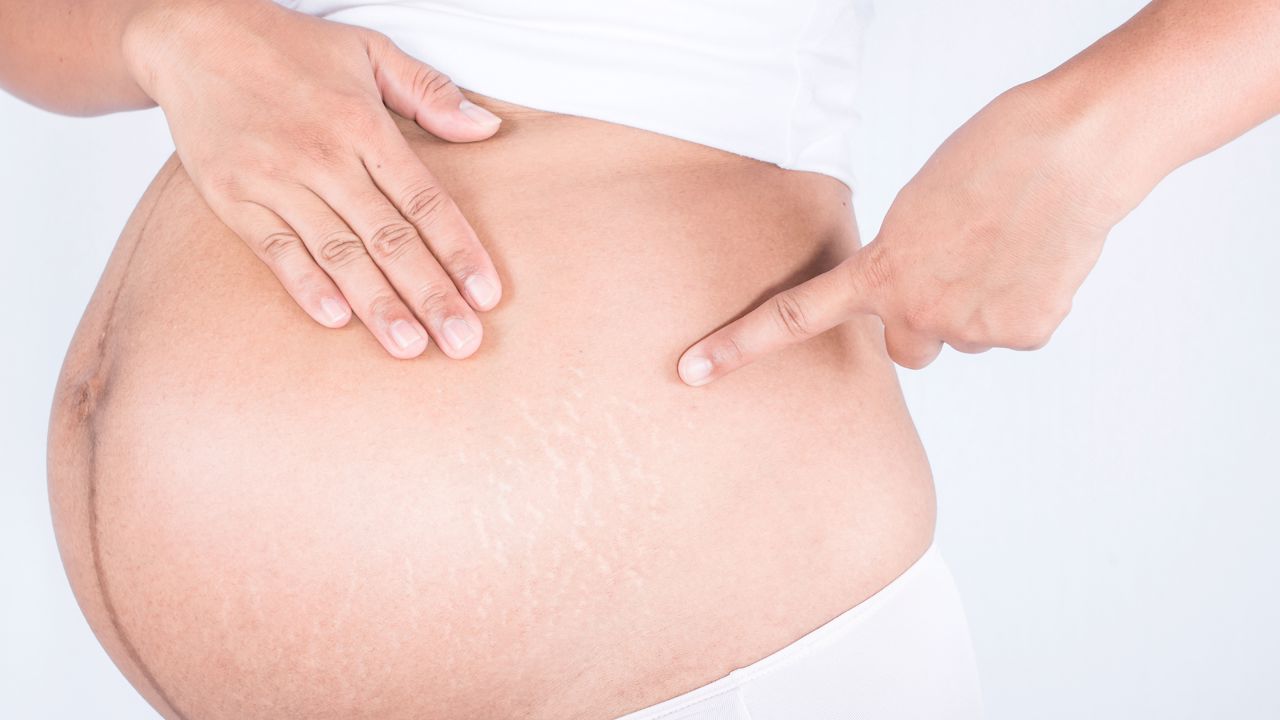 Le smagliature sono normali per tutte in gravidanza? Quali sono i fattori di rischio?