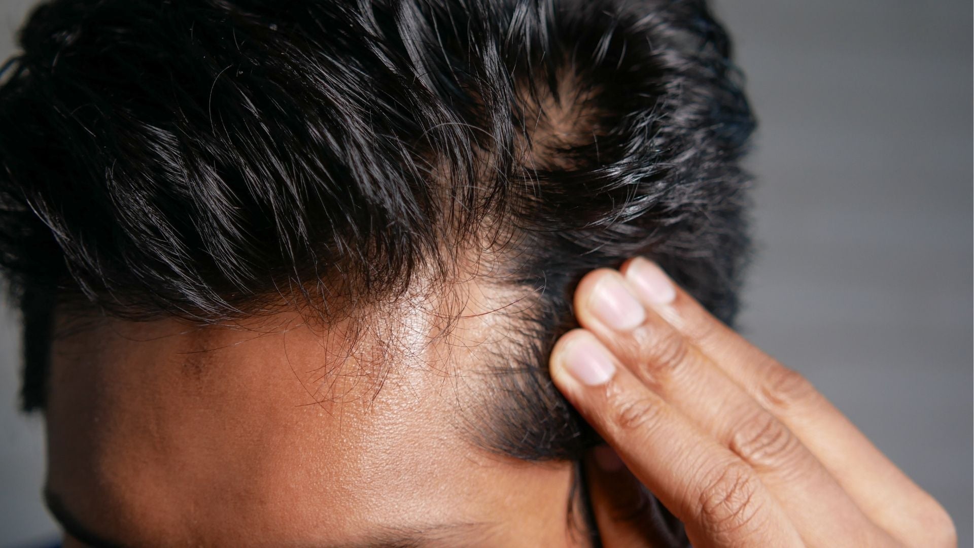 Caduta dei capelli negli uomini: perché molti cercano informazioni su Minoxidil e alternative naturali